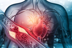 Hipertensiune arteriala: Cauze, Simptome, Tratament